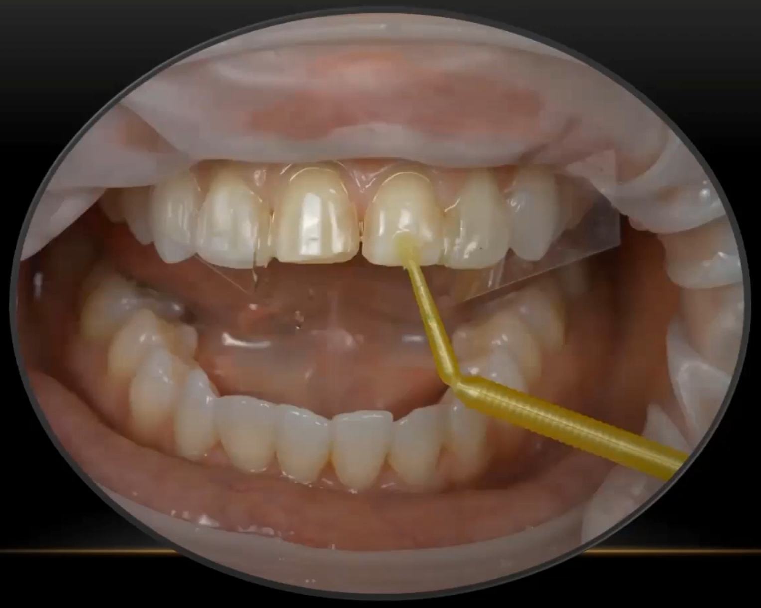 Viva Learning Dental Blog A Proven Approach for Veneer Cementation