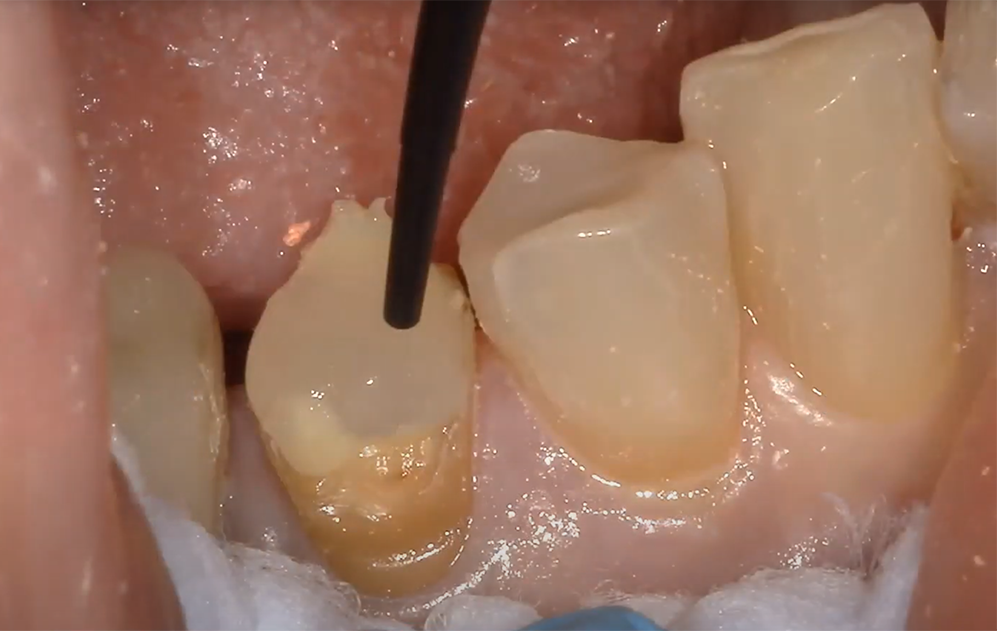 Fiber-reinforced restoration of a structurally compromised tooth